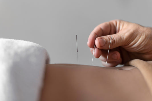 Acupuncture Initial Treatment